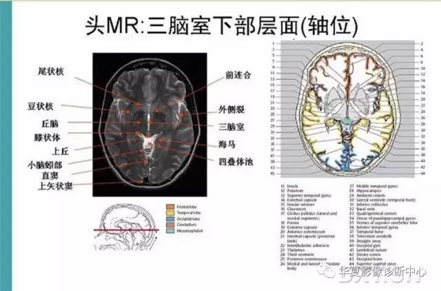 电子版头颅ct与mri断层解剖,头颅mri血管解剖与分段详解
