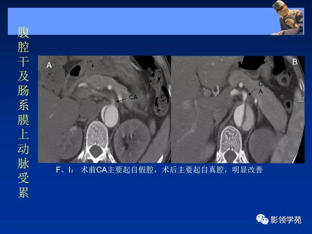 主动脉夹层壁间血肿如何鉴别,主动脉夹层血肿溃疡