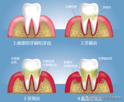 牙龈经常出血会不会是癌症的症状,牙龈一吸就出血会癌症吗