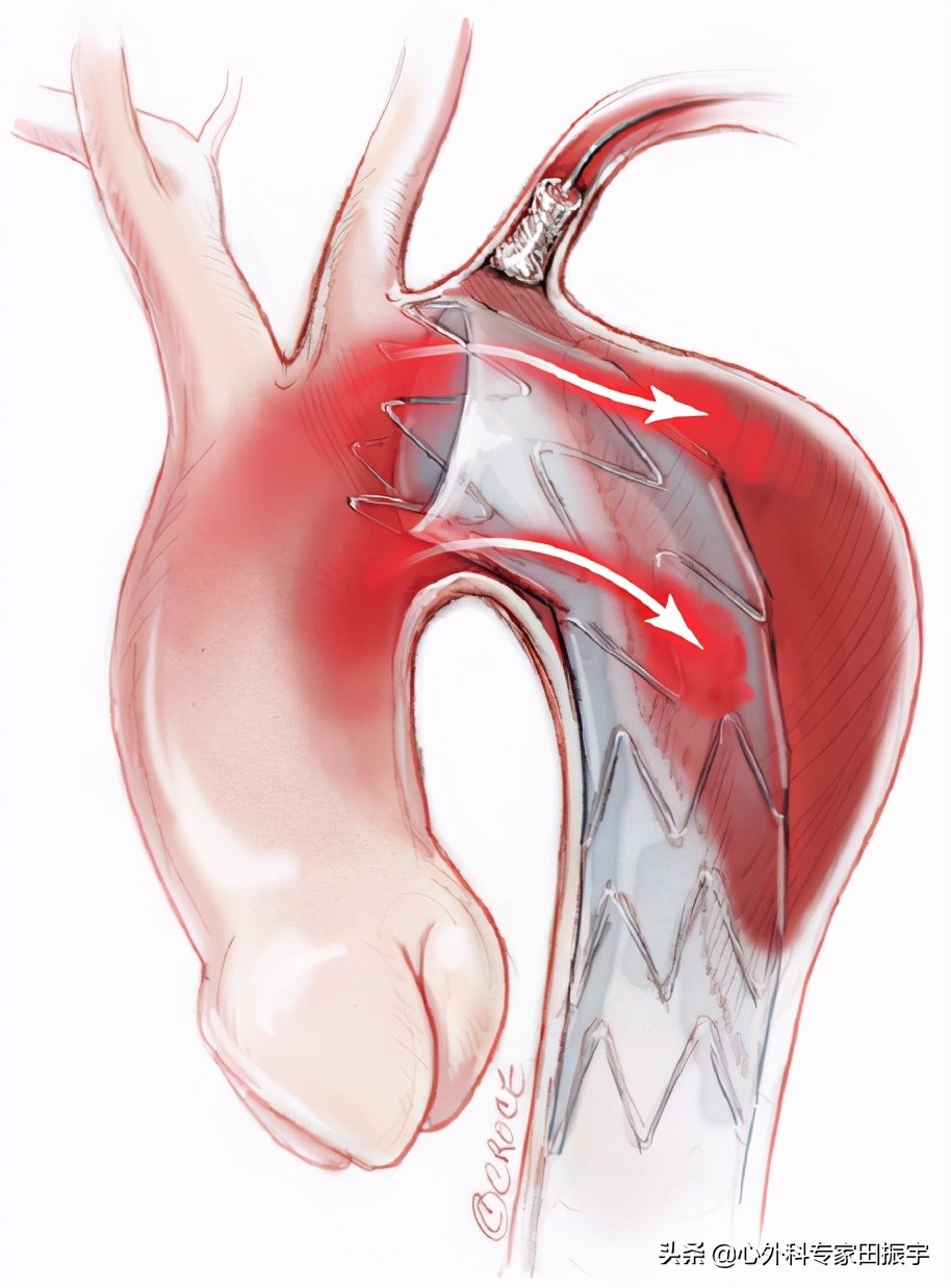 急性B型主动脉夹层合并主动脉破裂的急诊处理
