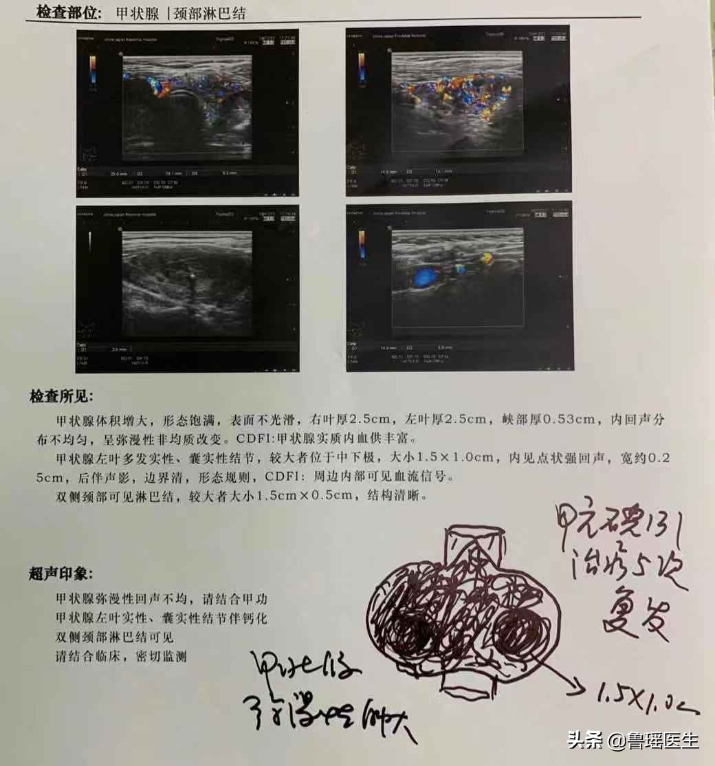 甲亢用过碘131还会复发吗,甲亢用碘131治疗好的患者案例