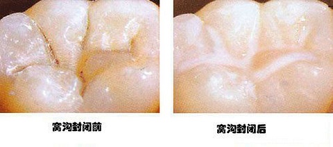 牙齿有一点点黑线怎么处理,牙齿上有黑线怎么补救