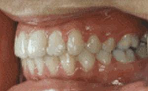 三d动画立体展示牙齿矫正全过程,3d牙齿矫正变化过程动图