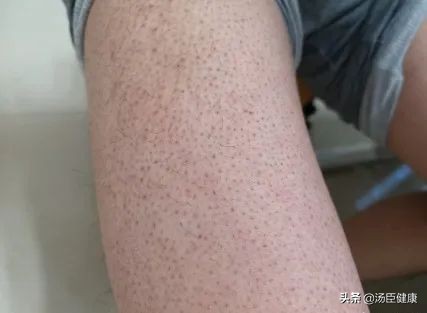 得了系统性红斑狼疮男朋友说分手,男生长了鸡皮肤