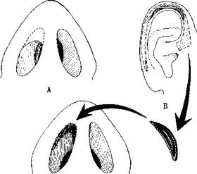 鼻道狭窄引起呼吸困难,先天性鼻道狭窄
