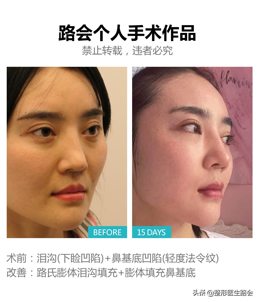 想做隆鼻的女孩,肋软骨填充鼻基底会拉长人中吗