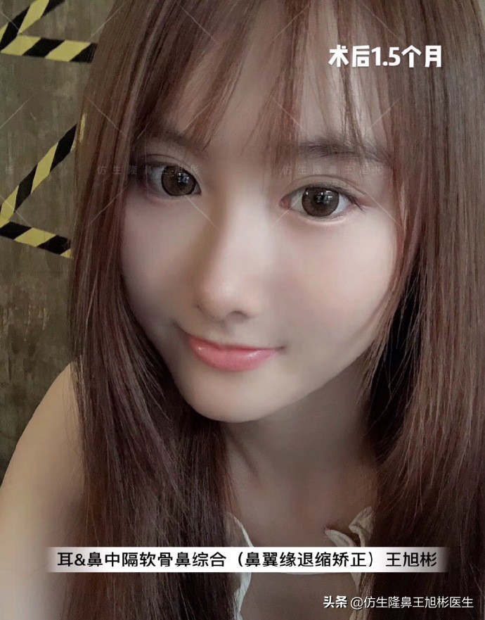 王旭彬：朝天鼻、露鼻孔，模特菲菲短鼻矫正手术后1.5个月