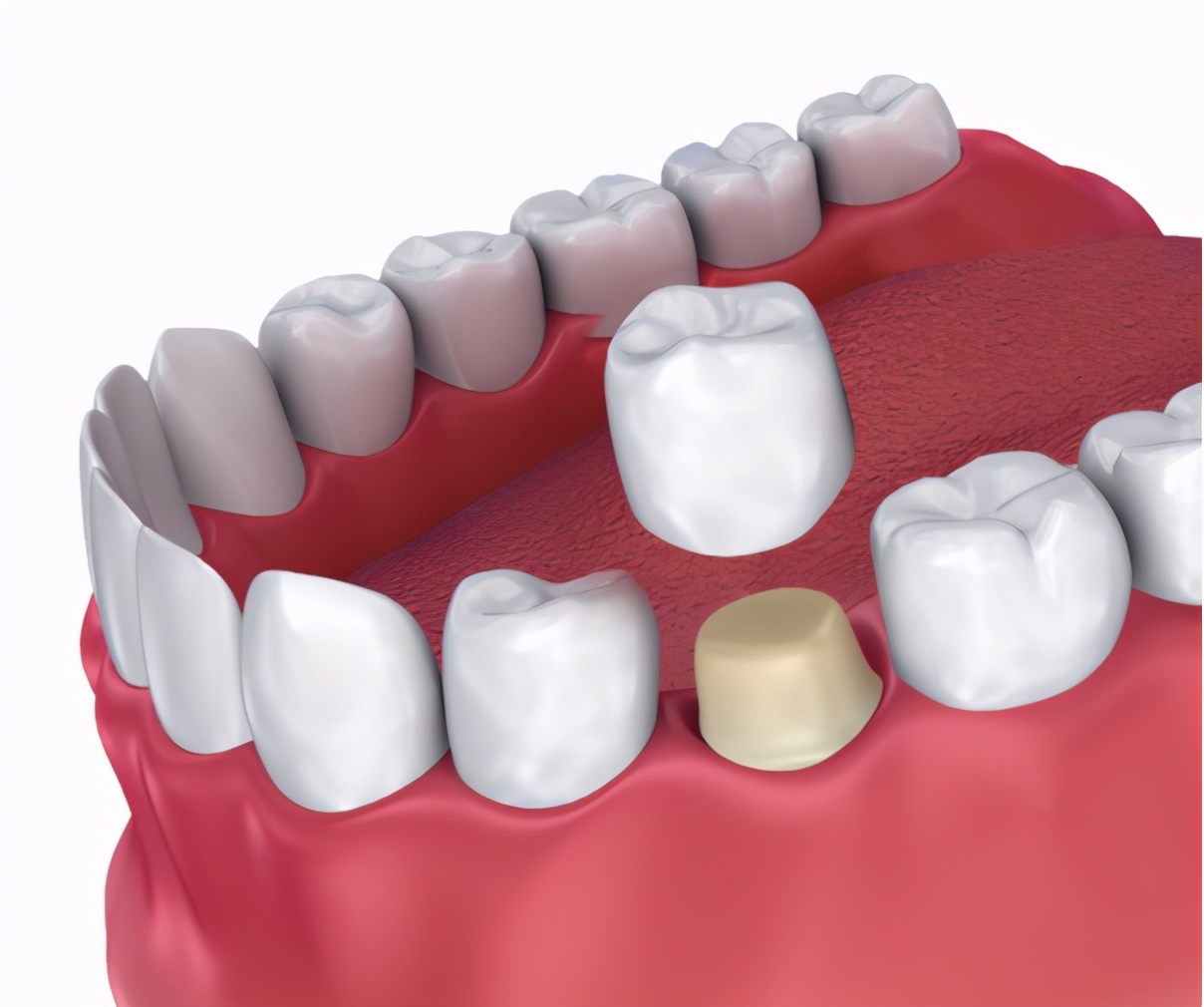 蛀牙补牙了材料老是会掉,为什么我补牙的材料是黑色的