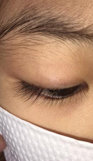 5岁女孩总揉眼睛,一检查取出20多只虱子……还在动