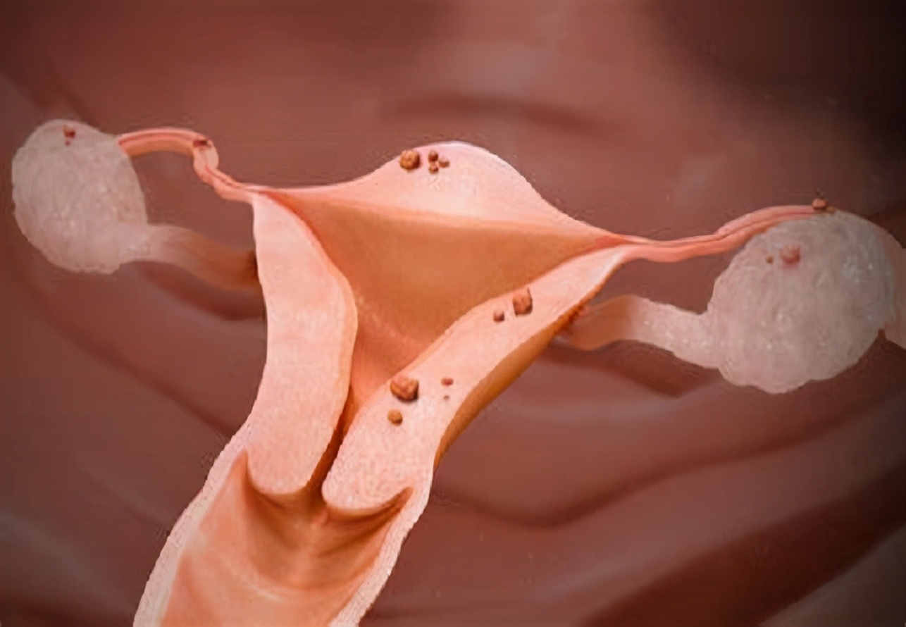 子宫内膜异位症能怀孕,子宫内膜异位症的病因