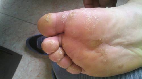 火针治疗跖疣有效果吗,火针点刺治疗跖疣