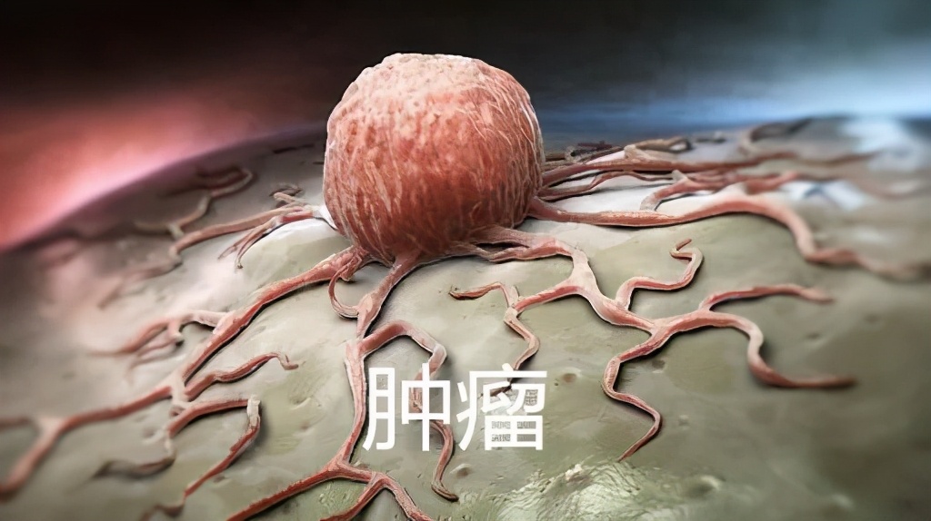 淋巴结核导致淋巴癌可能性,淋巴结核严重了会致命吗