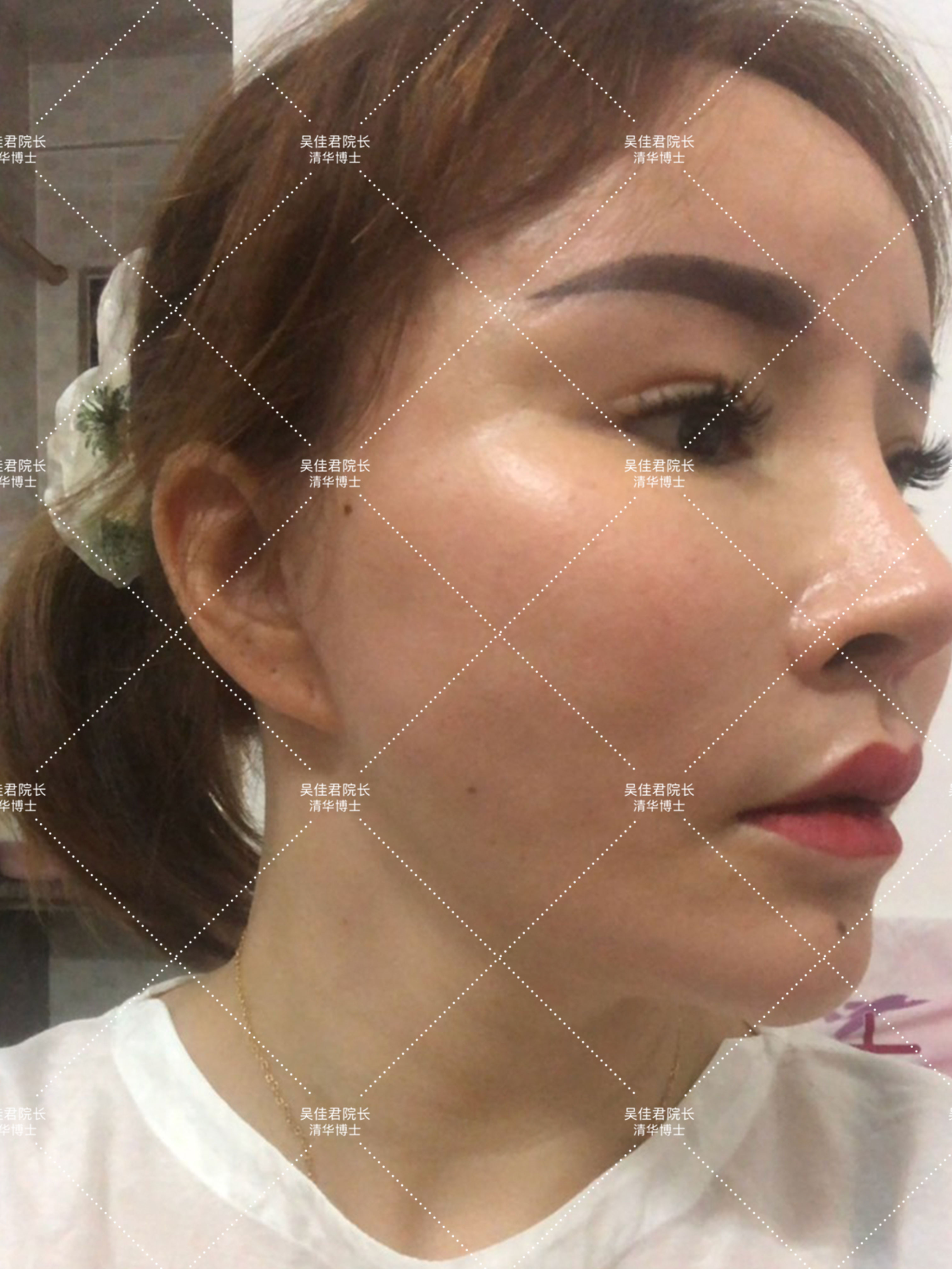 做小拉皮术后怎么保养,做拉皮手术的亲身经历注意事项