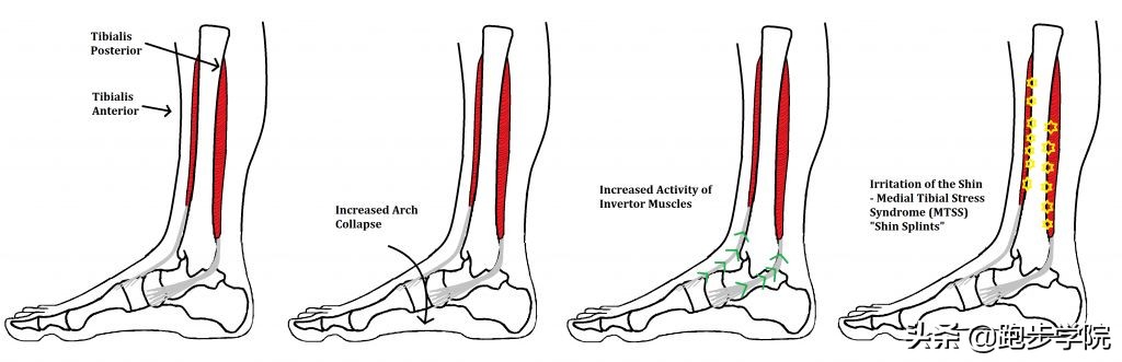 伤害了1/3跑者的胫骨炎,请务必重视起来