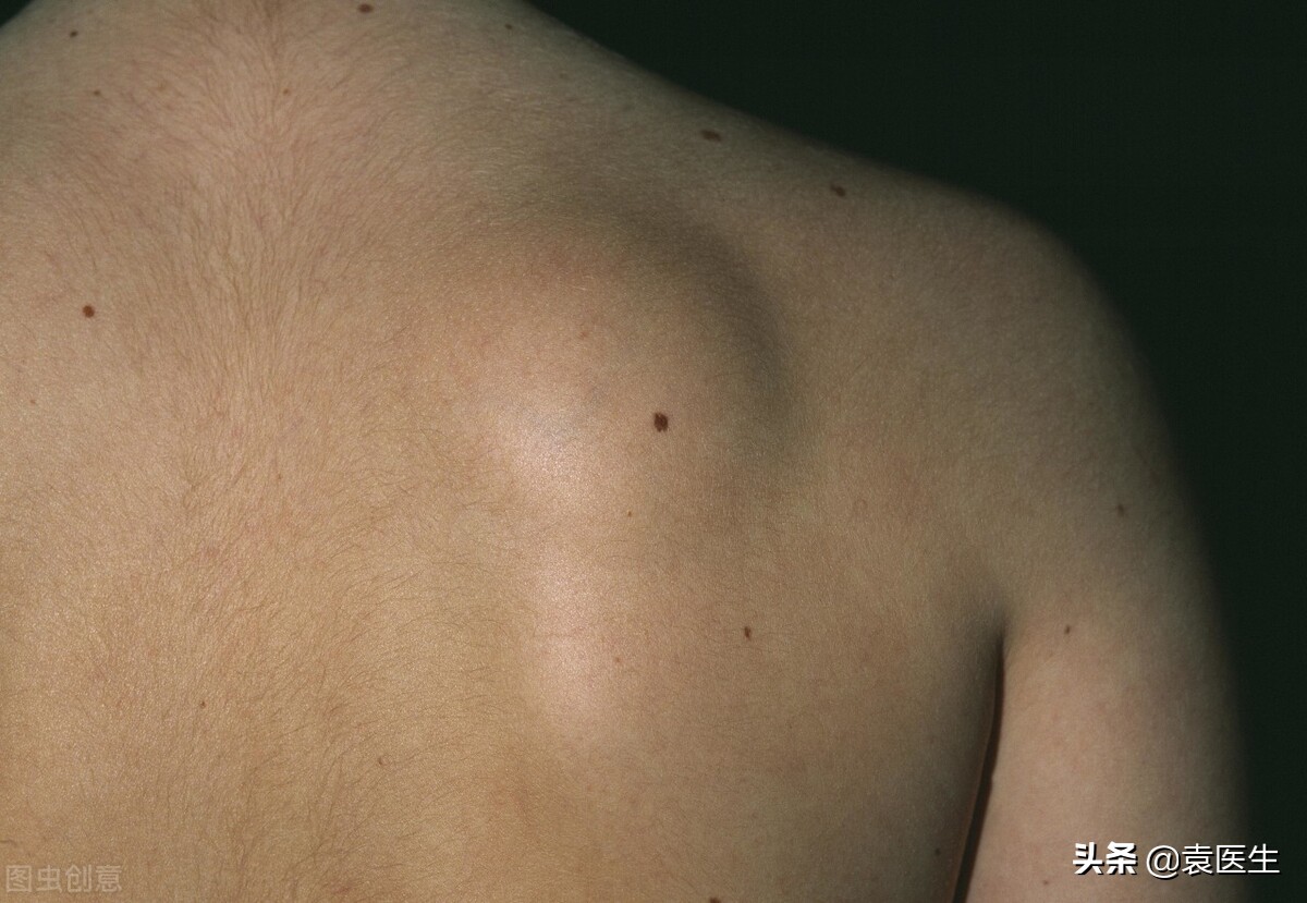 岳云鹏脂肪瘤是怎么回事,岳云鹏得过腮腺混合瘤