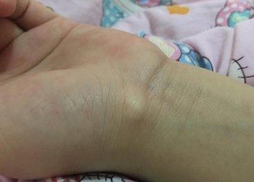 写字写多了手上有个包怎么办,手上无缘无故起个包按着很疼