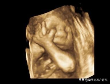 四维检查是好的但生下宝宝脚内翻,四维彩超通过后胎儿还会畸形吗