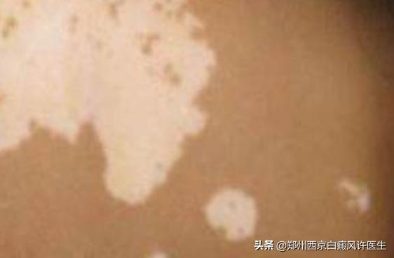 影响白癜风疗效因素,对白癜风影响最大的因素