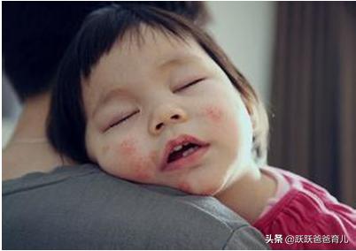 治疗湿疹的最好土办法除根,治疗湿疹图片