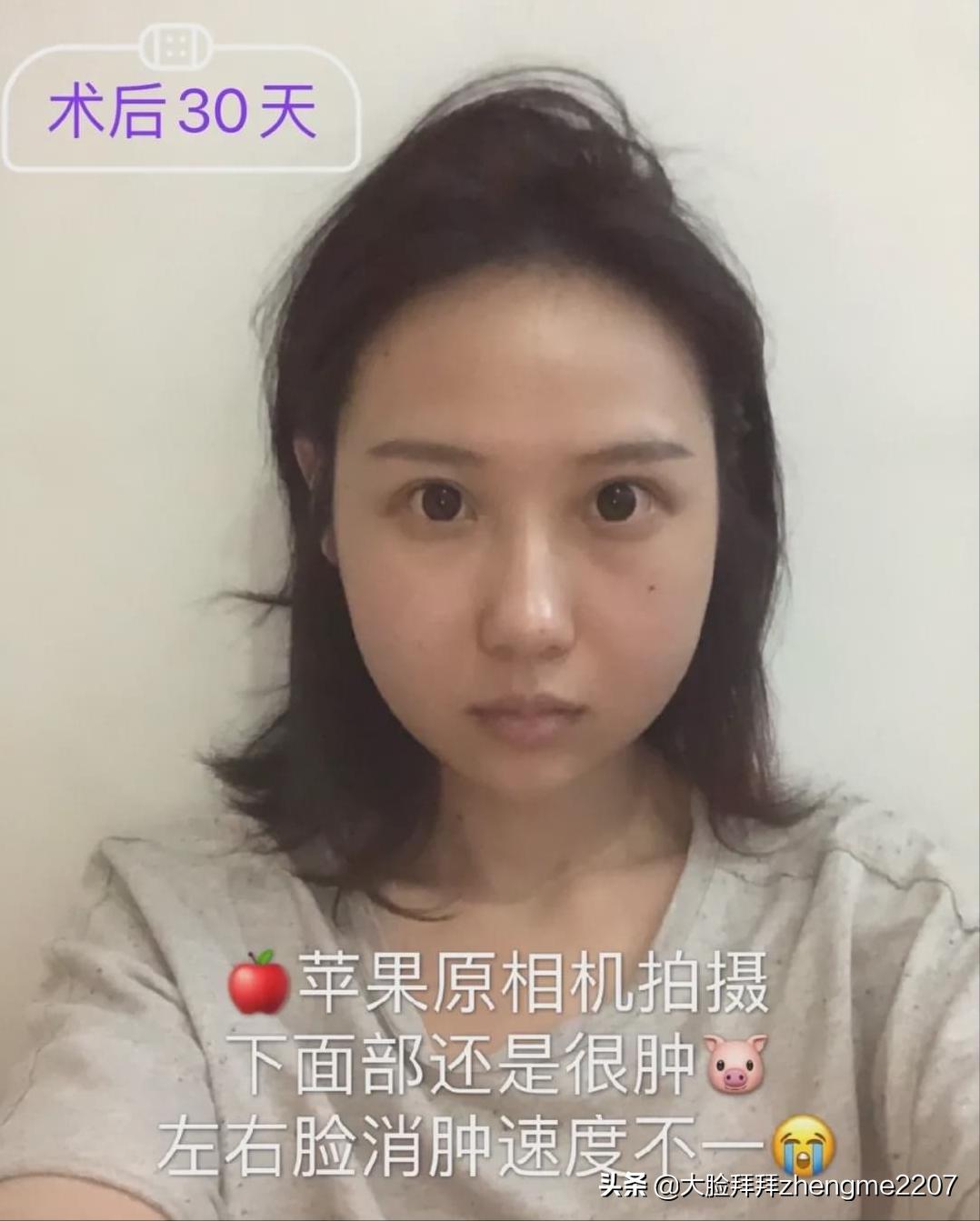 颧骨颧弓内推手术全过程真人,颧骨内推颧弓手术恢复全过程分享