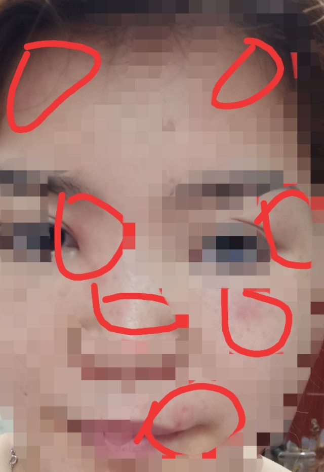 中医慢性荨麻疹自愈经验,慢性荨麻疹中医吃了还是痒