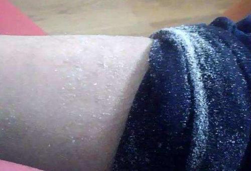 冬季脸干燥用什么护肤,冬季皮肤干燥过敏怎么回事