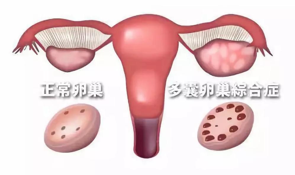 肥胖导致的闭经怎么解决,闭经导致不孕不育