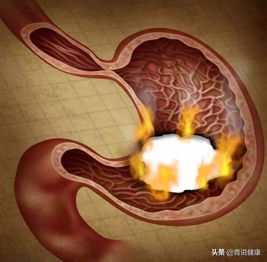 7岁男孩胃癌的症状,小男孩得了胃癌有什么症状