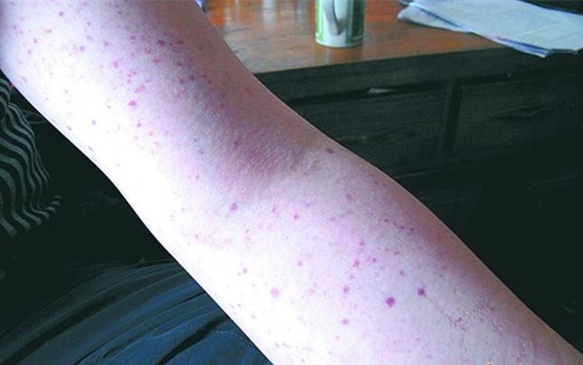 儿童突然出现大面积皮疹,孩子身上起皮疹用什么药