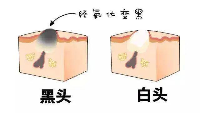 医院皮肤科医生怎样祛除黑头,医生黑头粉刺去除的过程