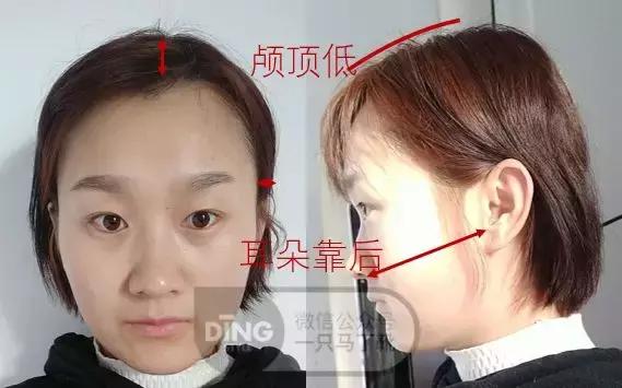 颅顶太低如何自救,颅顶低怎么自救