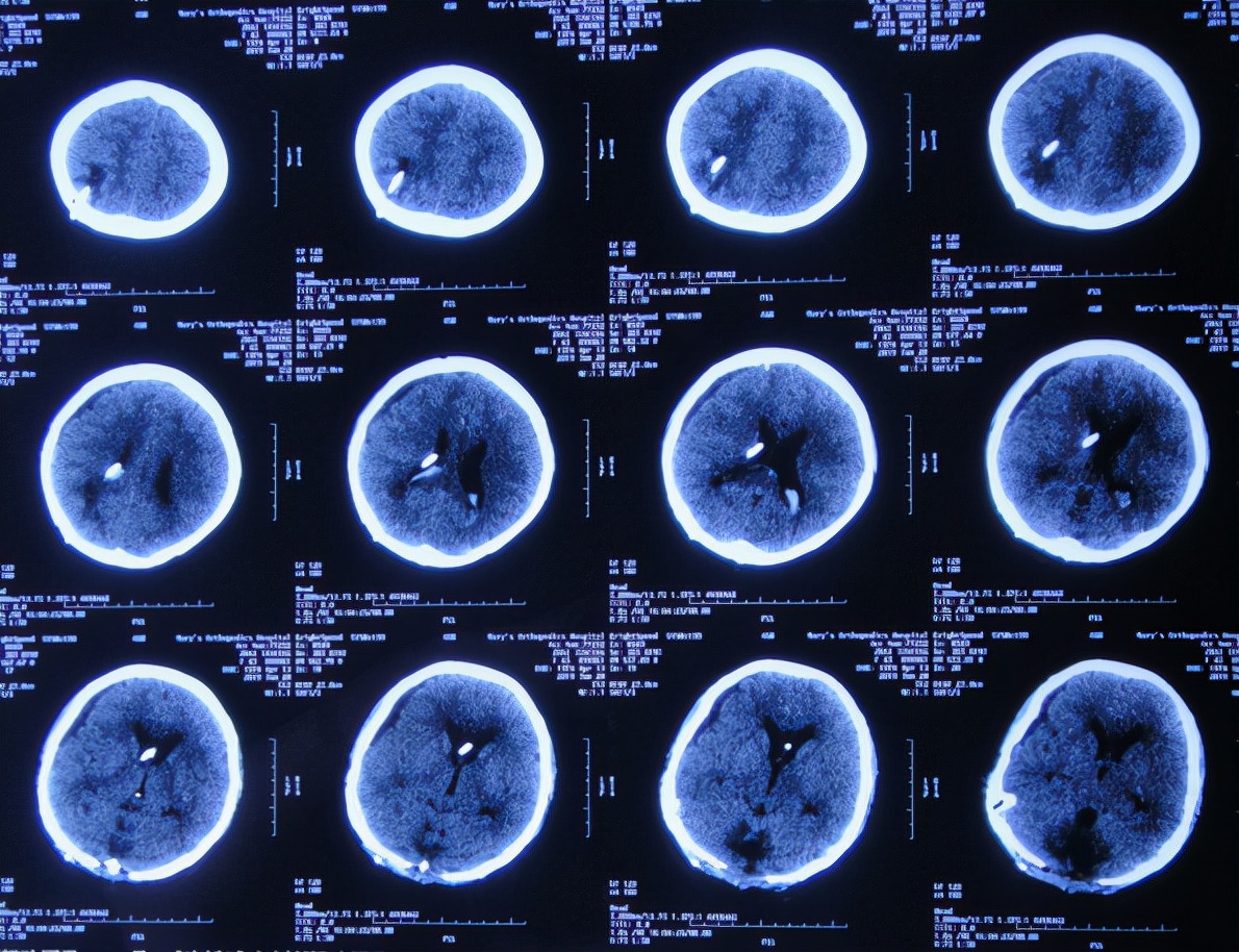 脑出血后脑积水会造成意识不清吗,脑出血后脑积水发高烧危险期多久