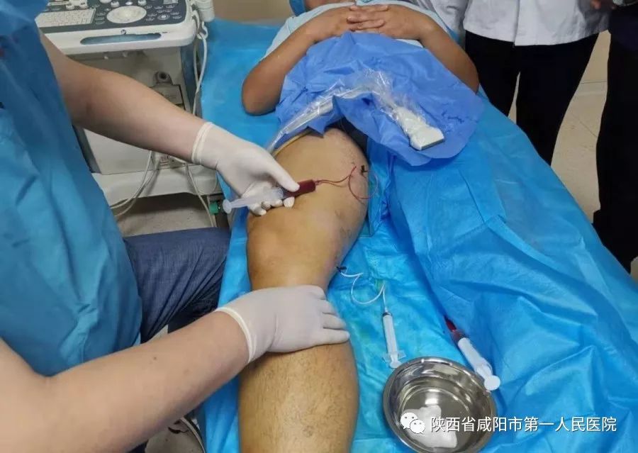 下肢静脉曲张微创手术是什么手术,下肢静脉曲张微创手术优点和缺点