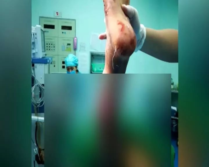 被熊咬伤要打狂犬疫苗？医生：被老鼠咬也要打