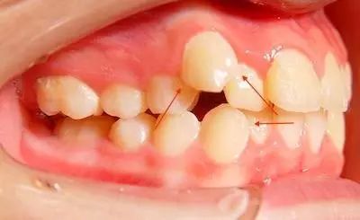 为什么吃东西会把牙磕掉,为什么吃东西后会牙齿出血呢