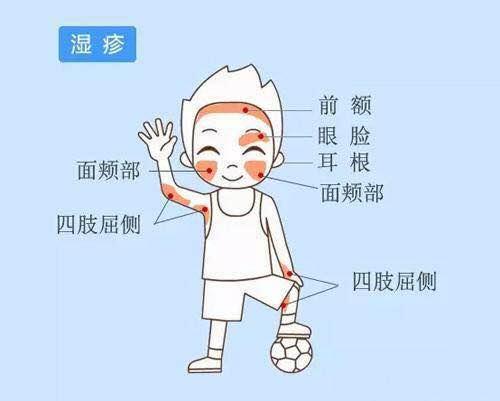 春季婴儿湿疹高发怎么办,春季湿疹高发的原因