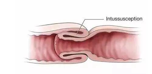 小儿肠套叠是什么原因发生的,小儿肠套叠有哪些症状表现