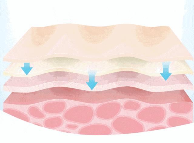 昕芙丽效果好吗,微针昕芙丽
