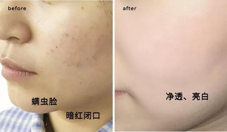 专治螨虫的洗面奶,螨虫专用洁面乳