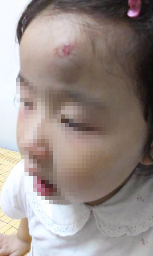 3岁孩子摔倒磕到前脑门怎么办,3岁小孩摔倒磕到头走路头疼