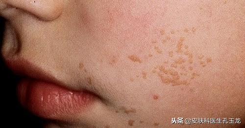 皮肤科疣有哪些,最常见的皮肤病扁平疣