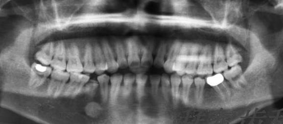 牙齿矫正方案动态图在哪里查看,牙齿矫正前后对比动态图