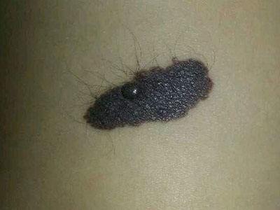 黑毛痣去除后的红印怎么去除,黑毛痣应该用什么方式才能去除