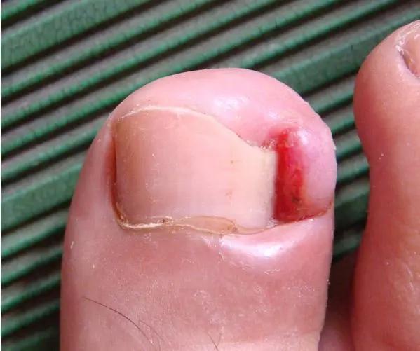 得了甲沟炎太疼了怎么办,甲沟炎疼痛难忍最有效办法