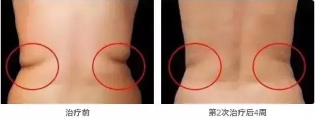 酷塑冷冻减脂可以减哪些地方,酷塑冷冻减肥效果