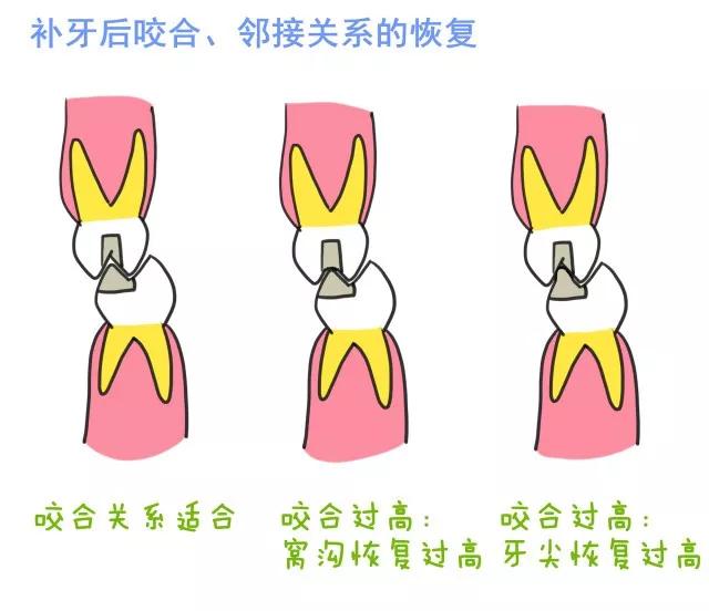 补牙后牙齿一敲就疼是咋回事呢,补牙的时候磨牙钻心痛怎么办