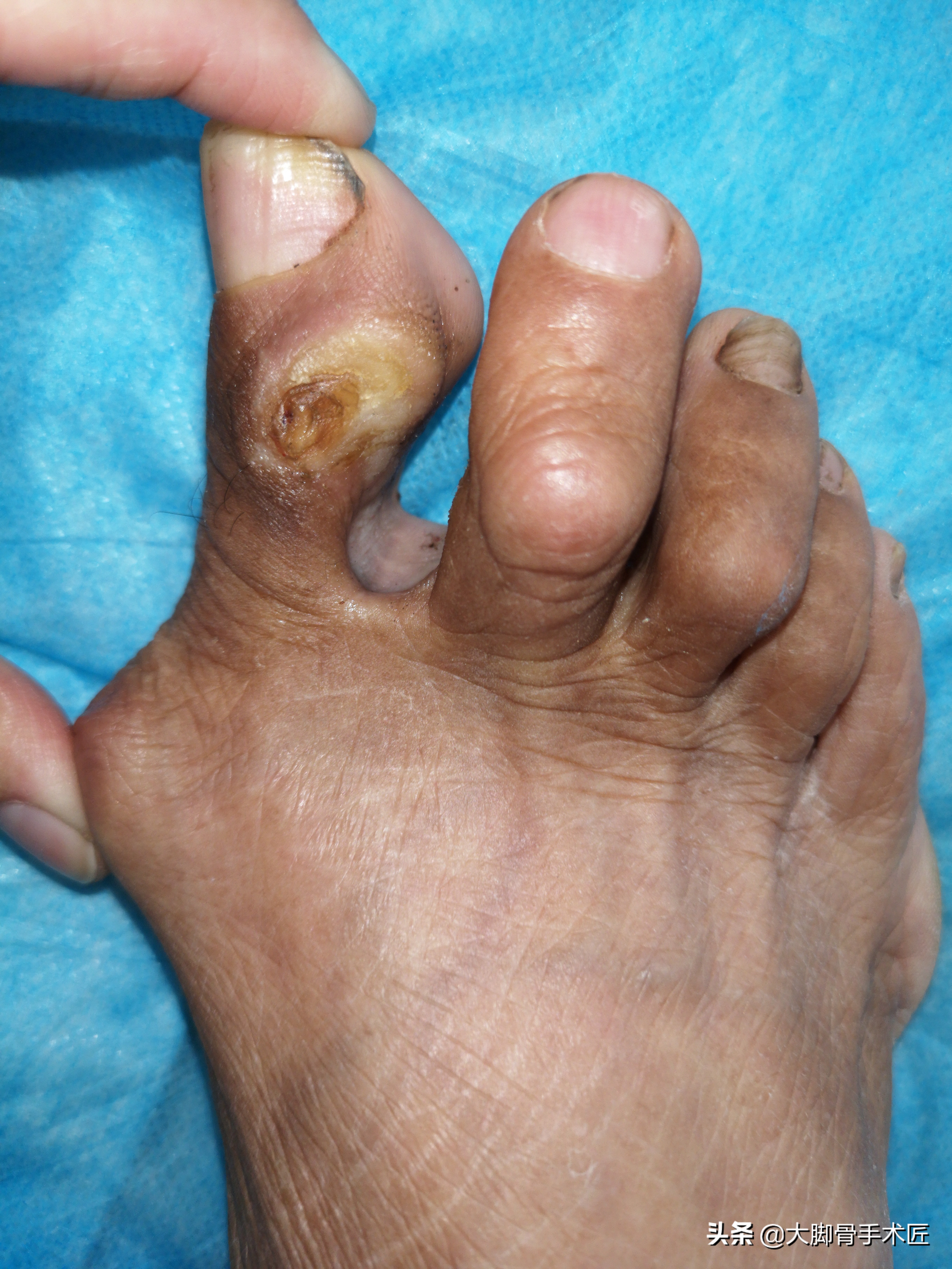 大脚骨导致哪里疼,大脚骨疼痛一招搞定