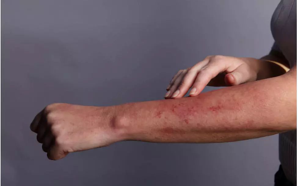 针灸针刺异常处理,针灸中出现的异常情况