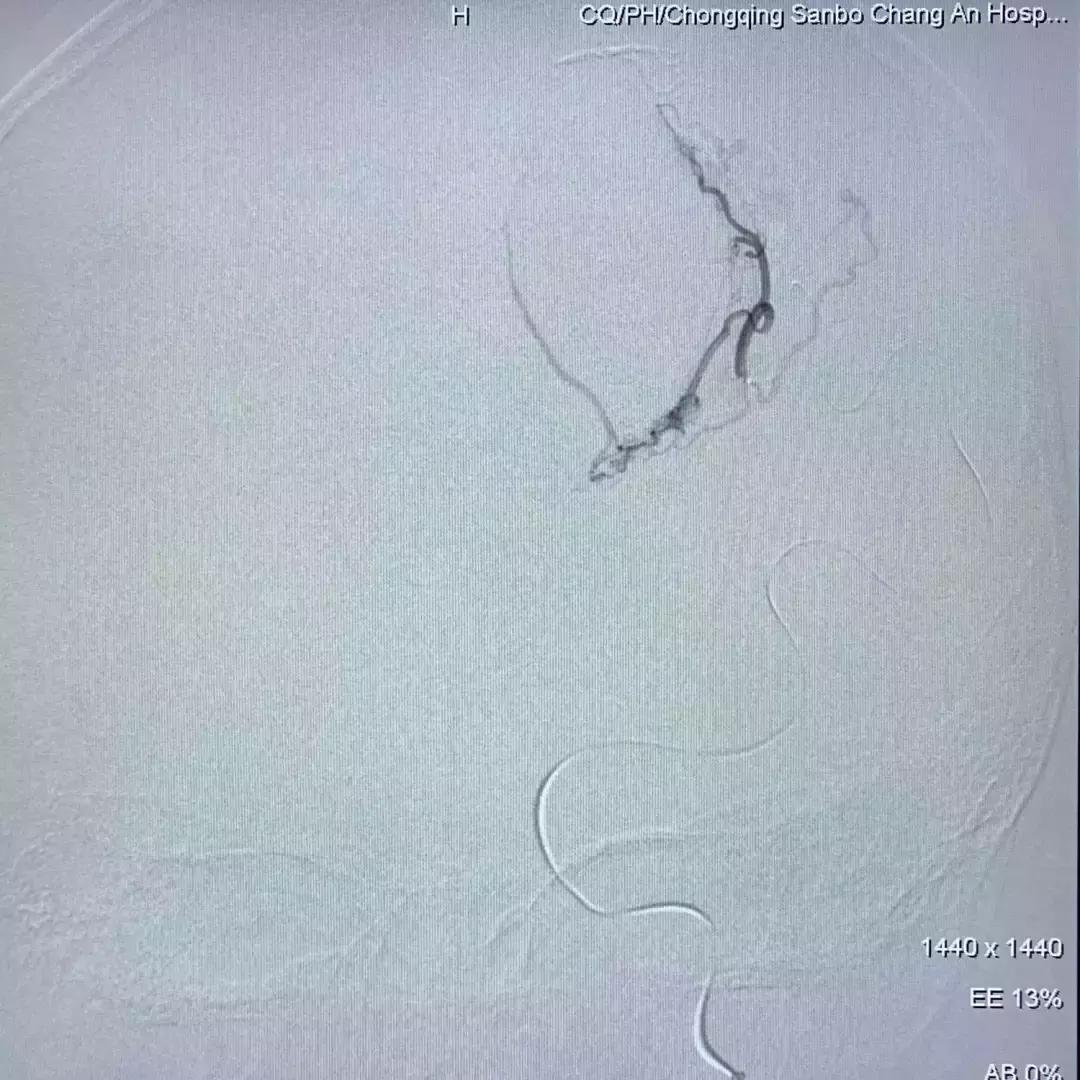 北京三博脑科医院康复治疗,北京三博脑科医院治脑血管瘤怎样