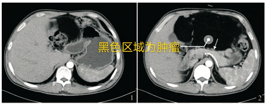 开腹腔切除肿瘤有危险吗 (腹腔内肿瘤割了又长)